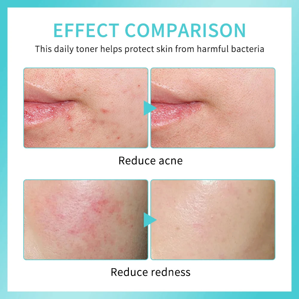 Hypochlorous Acid Spray Helps Reduce Redness Toner Skincare Sensitive Skin Hypochlorous Acid Spray Helps Reduce Redness