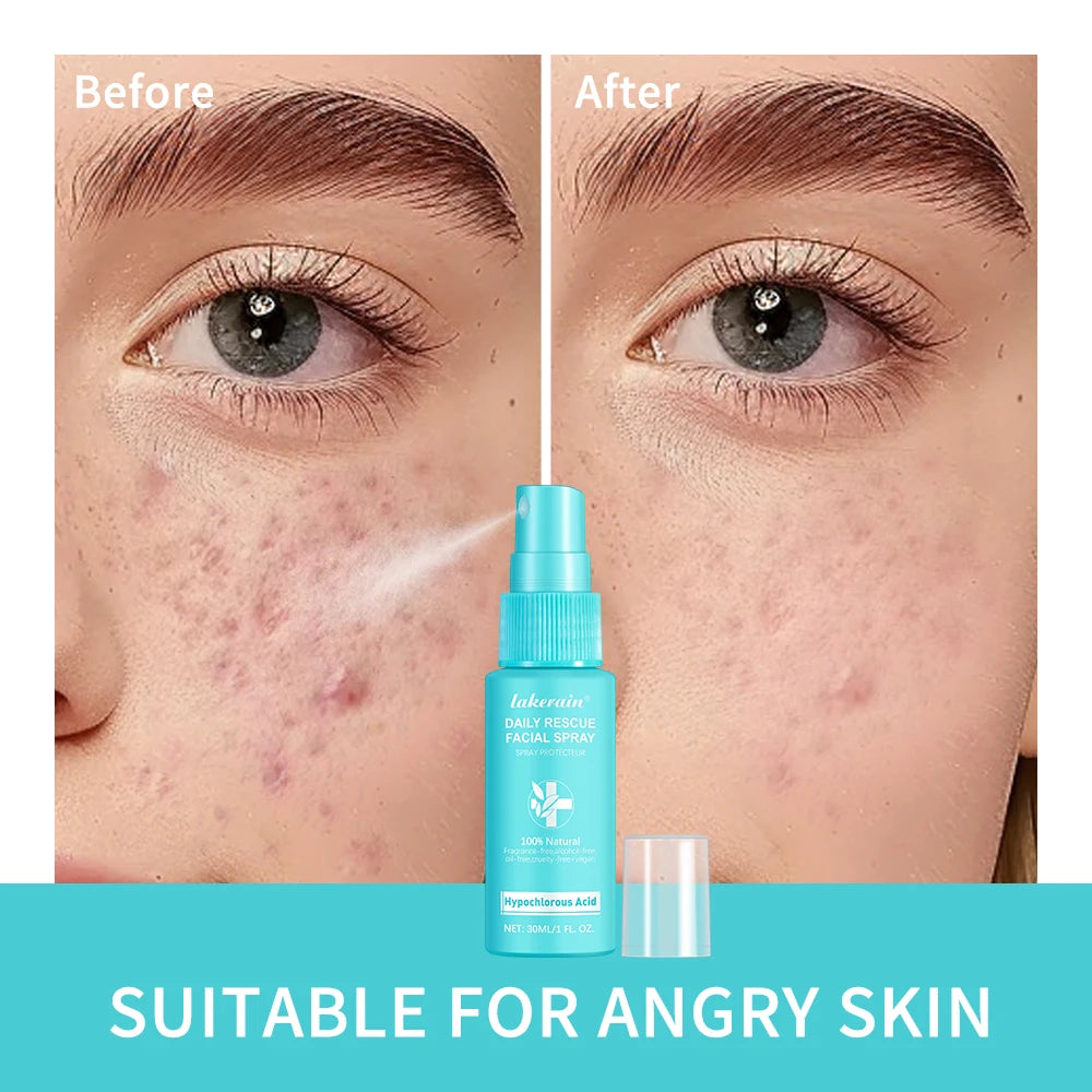 Hypochlorous Acid Spray Helps Reduce Redness Toner Skincare Sensitive Skin Hypochlorous Acid Spray Helps Reduce Redness